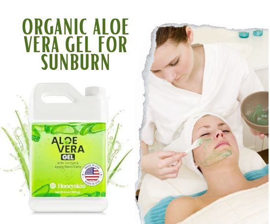 aloe vera gel for sunburn